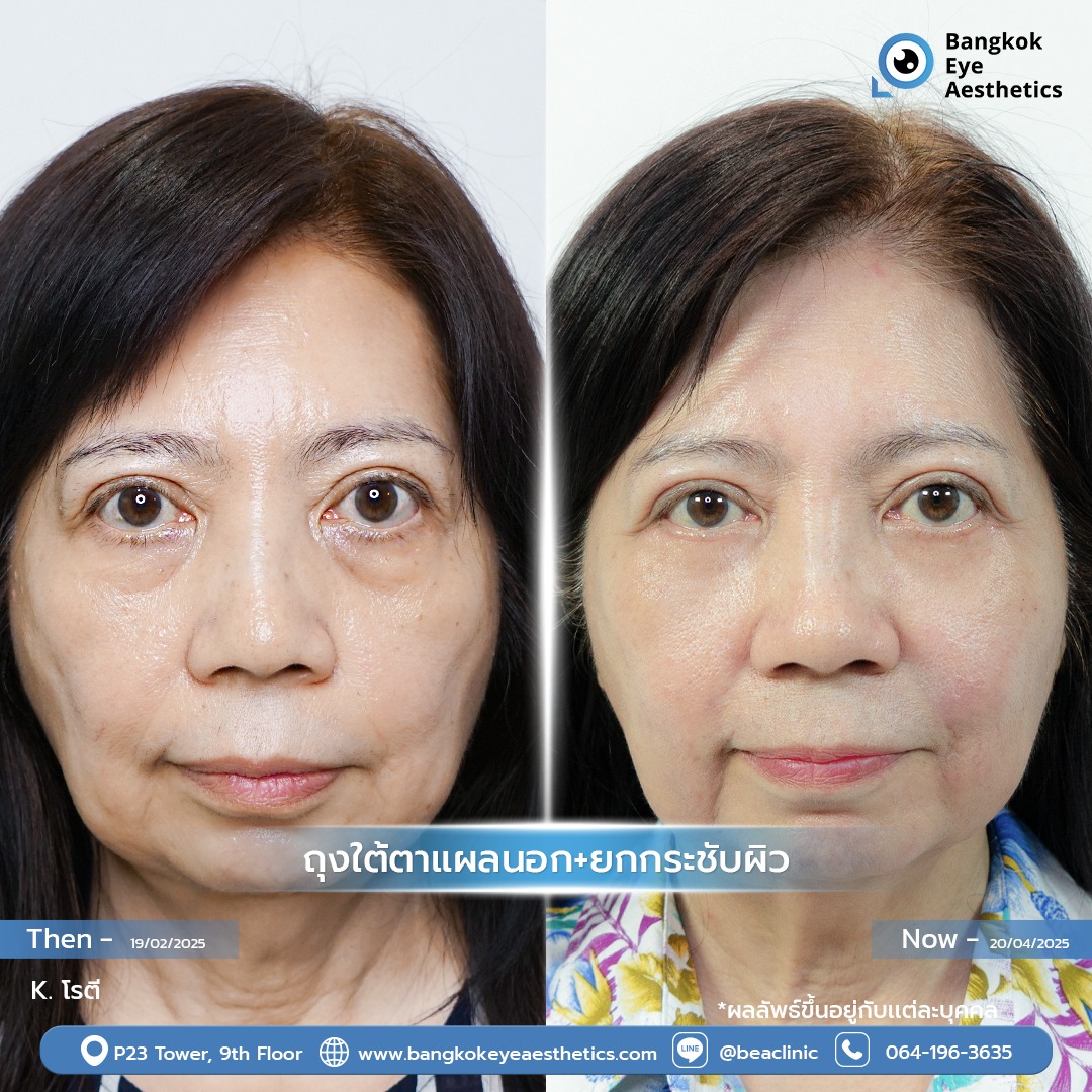 ผู้หญิงหลังการผ่าตัดถุงใต้ตาเป็นวิธีแก้ถุงใต้ตาที่มีประสิทธิภาพ