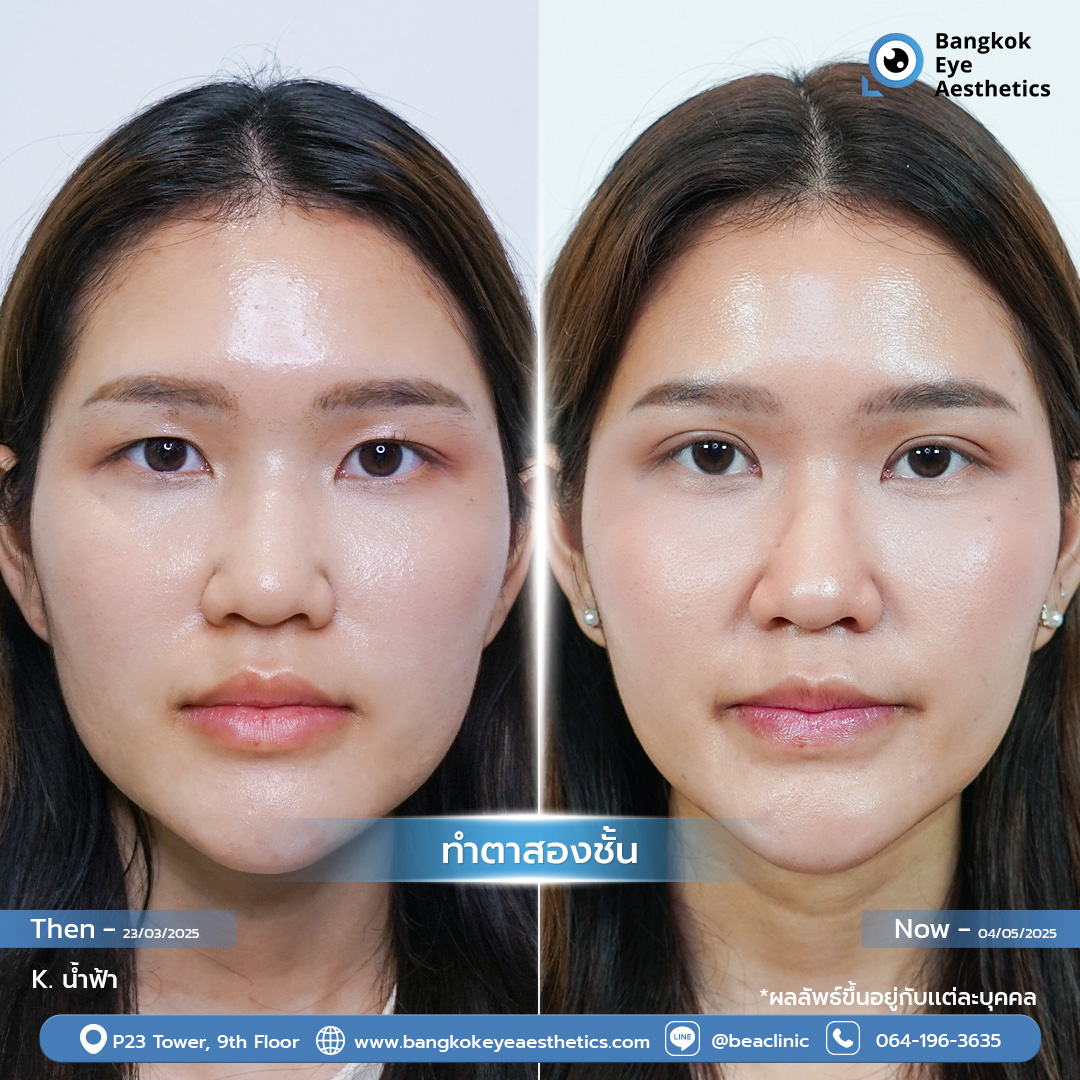 ผลลัพธ์หลังทำตาสองชั้น ทำให้เห็นชั้นตาที่ชัดเจนยิ่งขึ้น