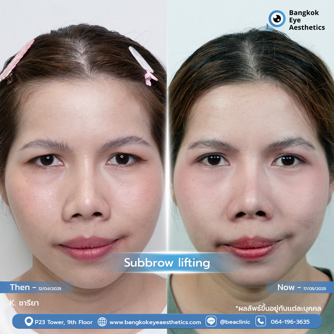 Subbrow Lifting