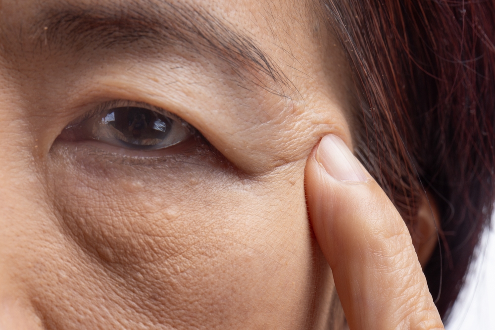 ผู้หญิงมีอายุมีปัญหาผิวรอบดวงตาและอยากแก้หนังตาตก