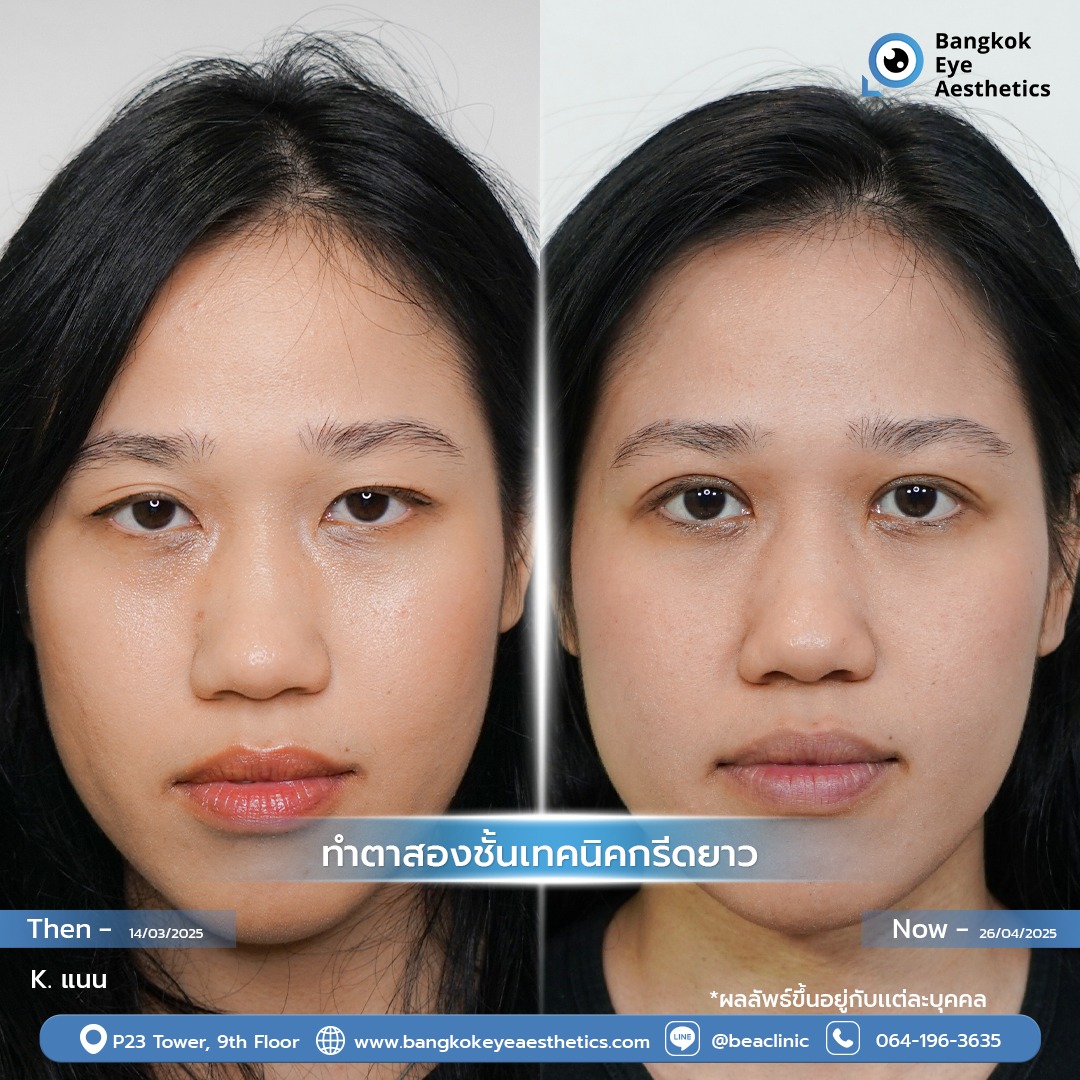 คลินิกทำตาสองชั้นที่เข้าใจปัญหาเกี่ยวกับชั้นตา