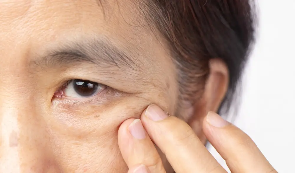 รวม 6 วิธีแก้หนังตาตก คืนความมั่นใจ เสริมโหงวเฮ้งให้ปังขึ้น