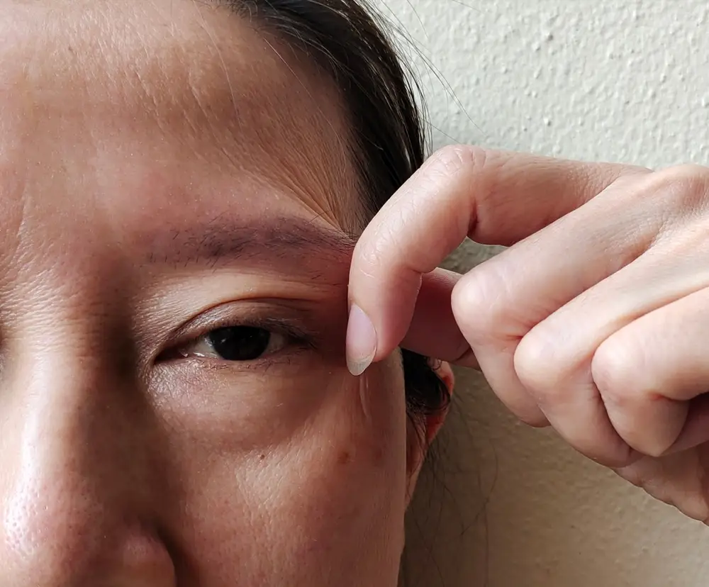 เปลือกตาหนา ไขมันเยอะ แก้อย่างไรให้หน้าหายโทรม ?